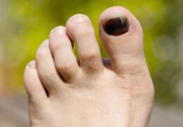 Symptoms associated with black toenails