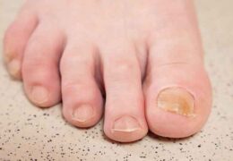 What causes yellow nails?